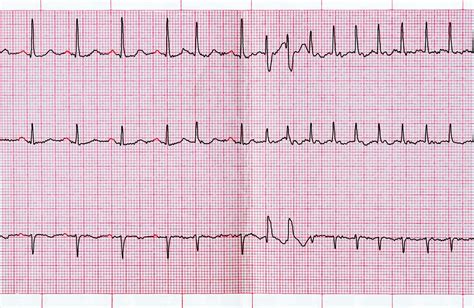 what does a abnormal ekg look like.
